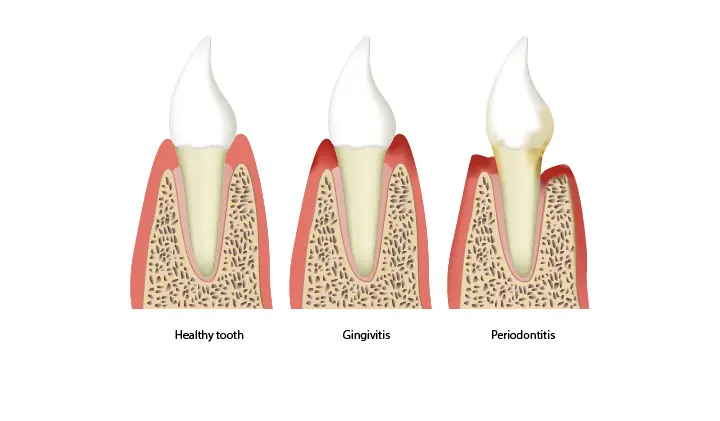 Periodontitis caused by inflammation of the gums