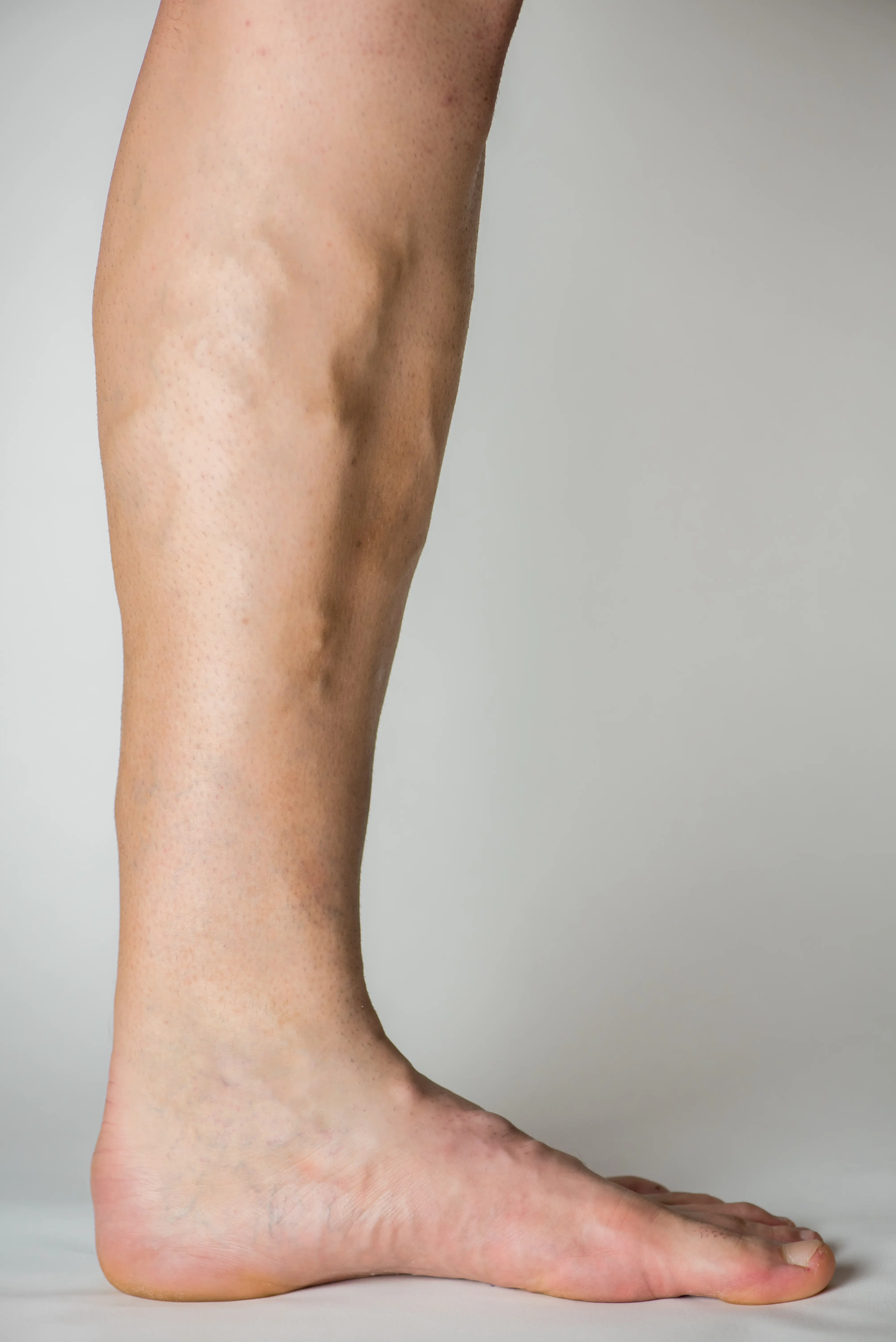 How leg ulcers form