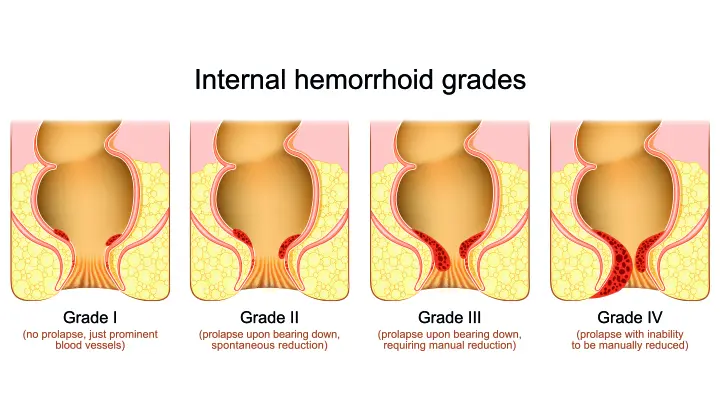 four stages of internal hemorrhoids